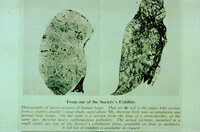 Human lungs exposed to pollution thumbnail