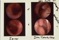 Divers Inner Ear: Sean's ear on left diving 9 Years, Don (surfer) diving 20 Years thumbnail